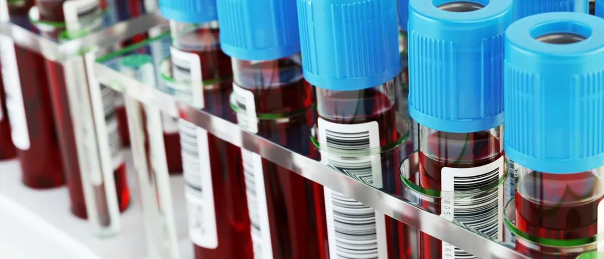 A rack of vials from a blood draw, blue tops